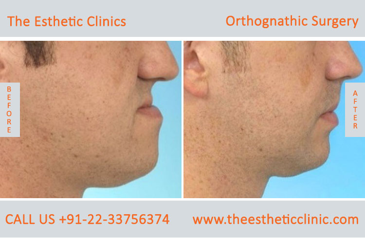 Orthognathic Surgery, Jaw Correction Surgery before after photos in mumbai india (6)